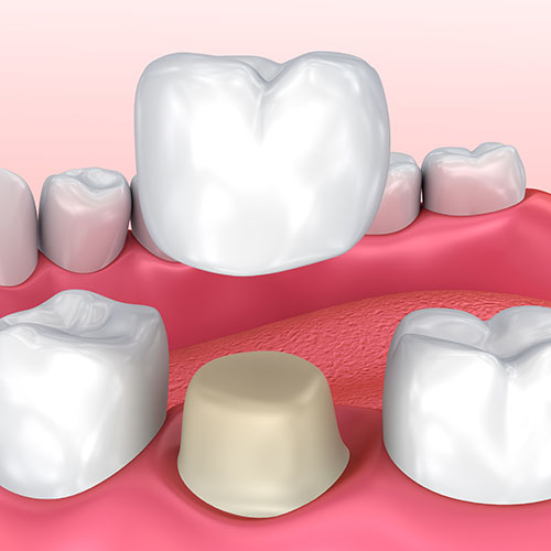 dental crown placement