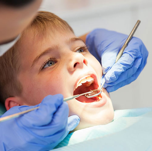 dental fillings