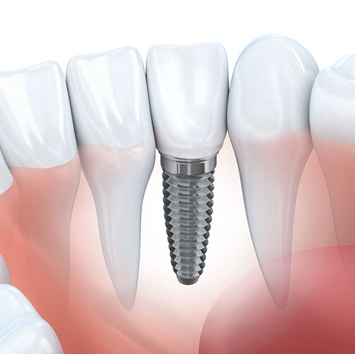 Dental Implant At Your Northridge Dentist
