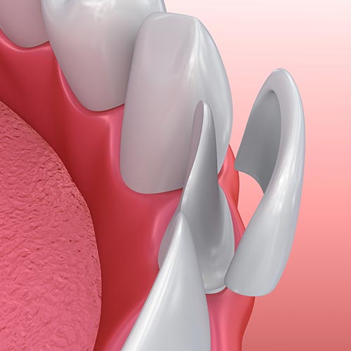 Veneers At Your Cosmetic Dentist Nanaimo, BC